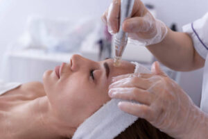 woman getting microneedling done on her face